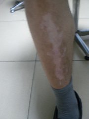 北京治疗白癜风专科医院：腿部白癜风有哪些症状